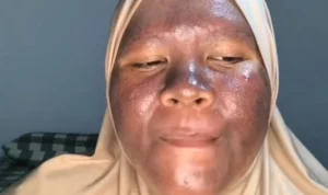 Wajah Gosong akibat Pemutih Viral di TikTok, Begini Kisahnya