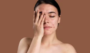 Viral! Wanita Mengalami Perubahan Kulit Wajah akibat Skincare yang Mengandung Merkuri