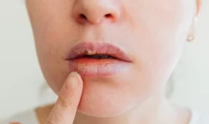 Ilustrasi mengatasi masalah bibir yang kering dan pecah dengan mudah. (freepik)