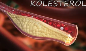 Ketehaui Penyebab Kolestrol Tinggi dan Cara Mengatasinya