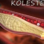 Ketehaui Penyebab Kolestrol Tinggi dan Cara Mengatasinya
