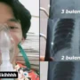 Viral di Twitter Kisah Pria Terkena Efusi Pleura, Apa Itu? Begini Penjelasannya
