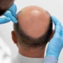 ILSUTRASI Cara mengatasi dan mencegah kebotakan rambut. (freepik)