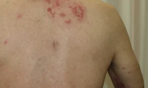 Wabah Herpes Zoster Bukan Sekadar Virus Biasa! Berikut Cara Mencegahnya Wabah Herpes Zoster Bukan Sekadar Virus Biasa!