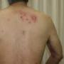 Wabah Herpes Zoster Bukan Sekadar Virus Biasa!
