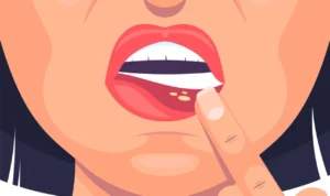 Ketahui 8 Obat Alami Yang Dapat Redakan Sariawan!