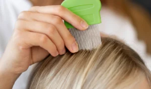 Berikut Ini Beberapa Cara Menghilangkan Kutu Pada Rambut!