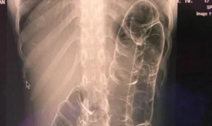 Viral Usus Wanita Naik ke Dada, Ternyata Hampir 1 Bulan Tidak BAB! Begini Cara Pencegahannya