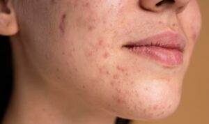 Cegah Flek Hitam di Wajah dengan 7 Bahan Alami Ini, Dijamin Kulit Langsung Glowing!