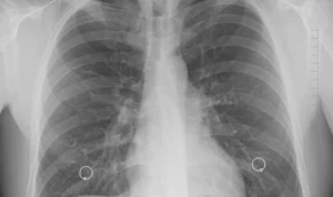 Perbedaan Pneumonia dan Mycoplasma yang Wajib Kamu Tahu Perbedaan Pneumonia dan Mycoplasma yang Wajib Kamu Tahu