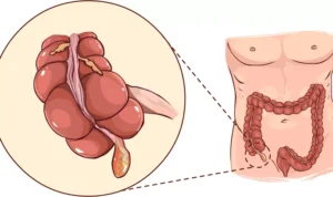 Waspadai 5 Kebiasaan Sepele yang Tanpa Sadar Picu Usus Buntu, Ini Penjelasannya!
