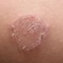 Cara Mengusir Kurap dengan 5 Senjata Alami, Dijamin Kaki Sehat dan Bebas Gatal!