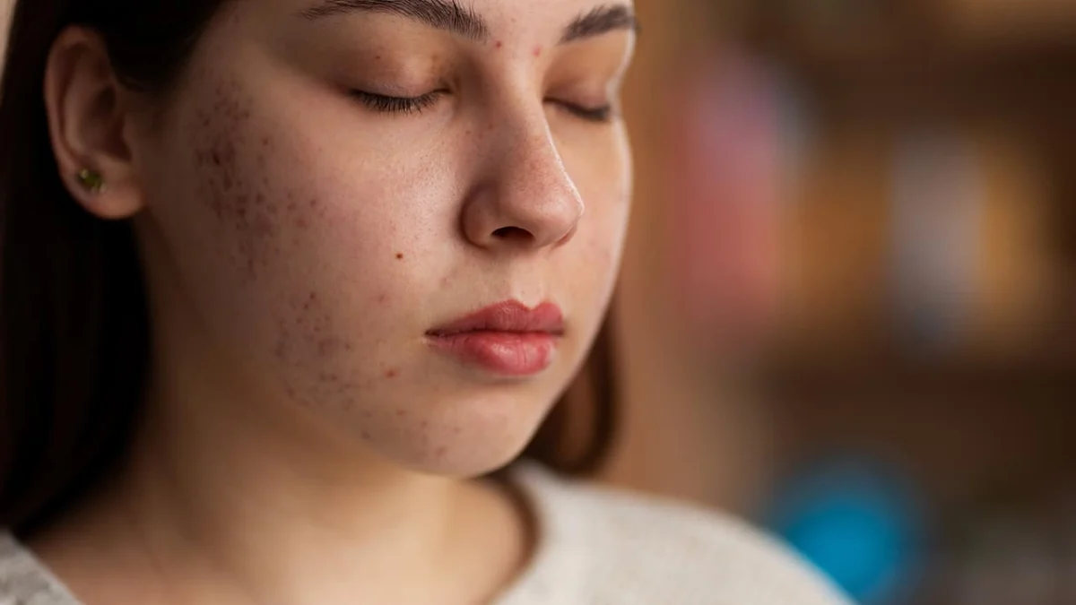 5 Cara Menghilangkan Flek Hitam, Bikin Wajah Jadi Glowing!