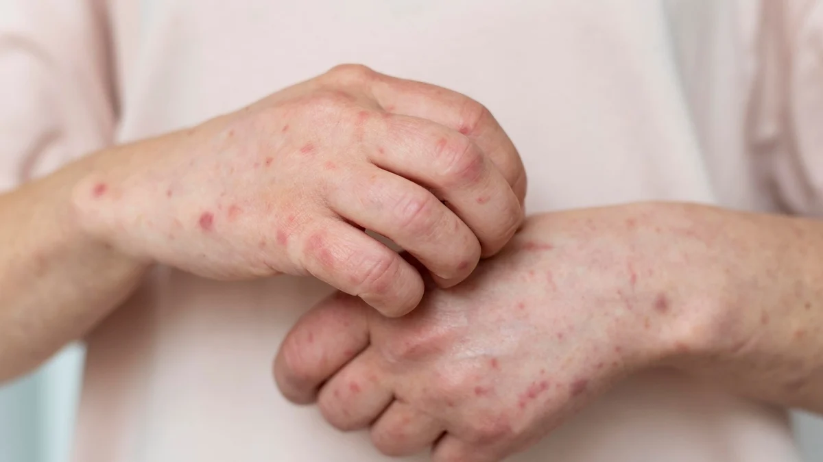 Jumlah Kasus Flu Singapura di Indonesia Tembus 5 Ribu, Peringatan dari IDI: Waspadai Gejalanya