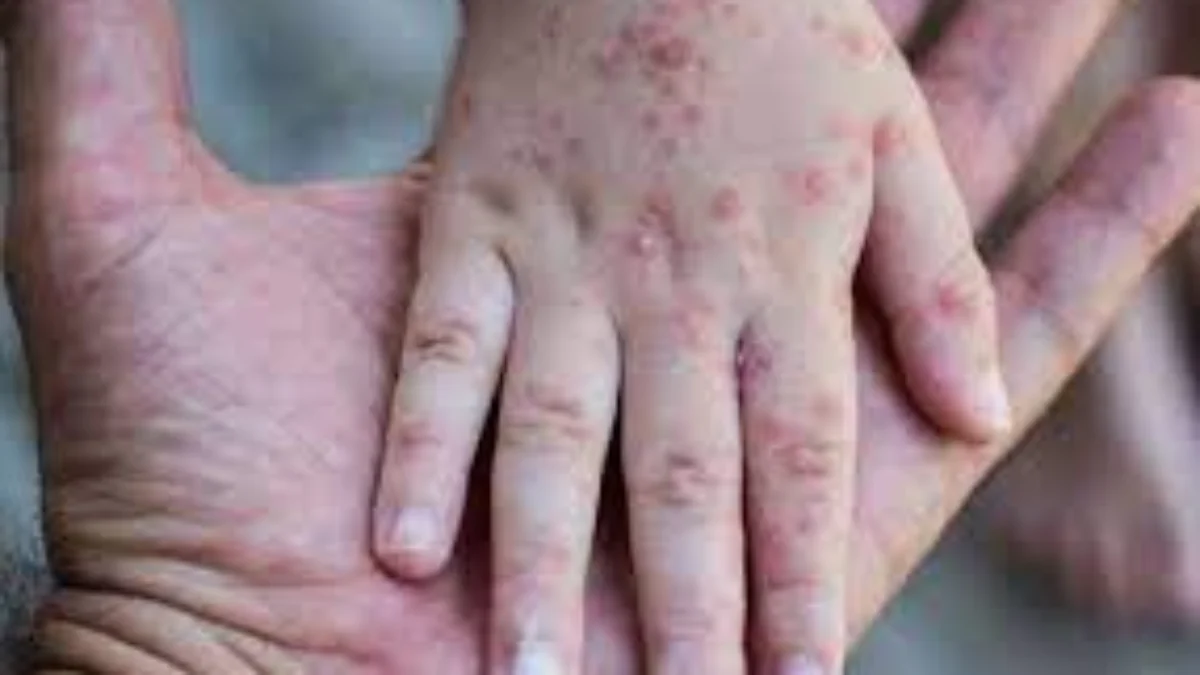 Musim Mudik Lebaran Mendekat, Simak 3 Langkah Penting untuk Menghindari Penularan Flu Singapura Musim Mudik Lebaran Mendekat, Simak 3 Langkah Penting untuk Menghindari Penularan Flu Singapura
