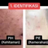 Rahasia Hilangkan Bekas Jerawat Hitam dengan 5 Langkah Sederhana!