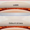 Apa Bedanya Antara Ortho-K dengan LASIK?