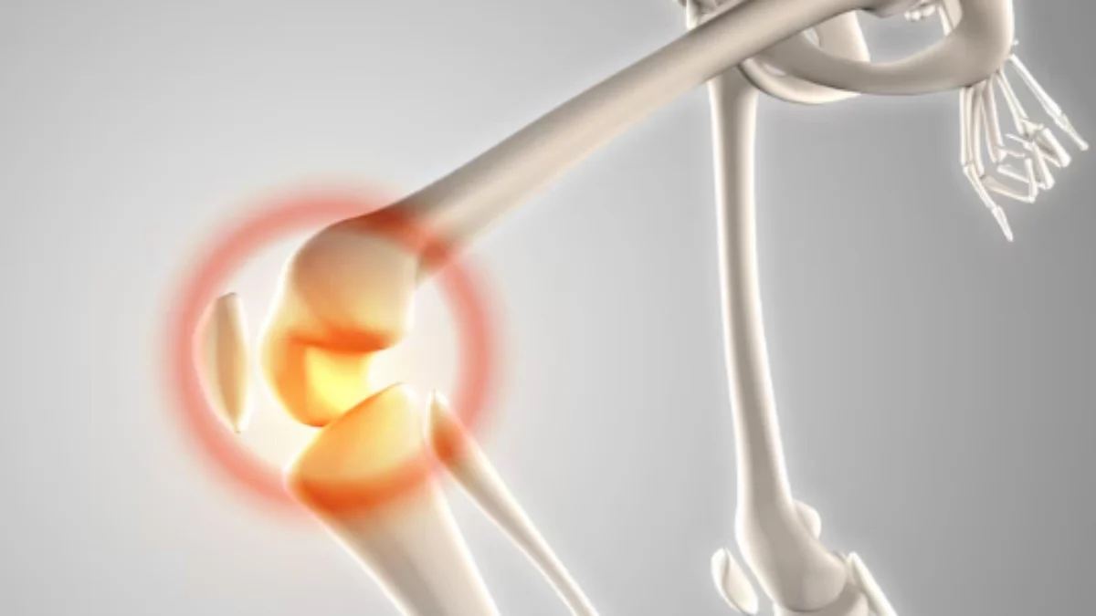 Awas Ternyata Anak Muda Juga Rentan Kena Osteoarthritis, Mager Jadi Salah Satu Penyebab Awas Ternyata Anak Muda Juga Rentan Kena Osteoarthritis, Mager Jadi Salah Satu Penyebab