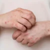 Apakah BPJS Kesehatan Menanggung Pengobatan Wabah Mpox, Begini Penjelasannya