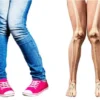 ILUSTRASI Kaki X yang bisa menjadi tanda-tanda Scoliosis