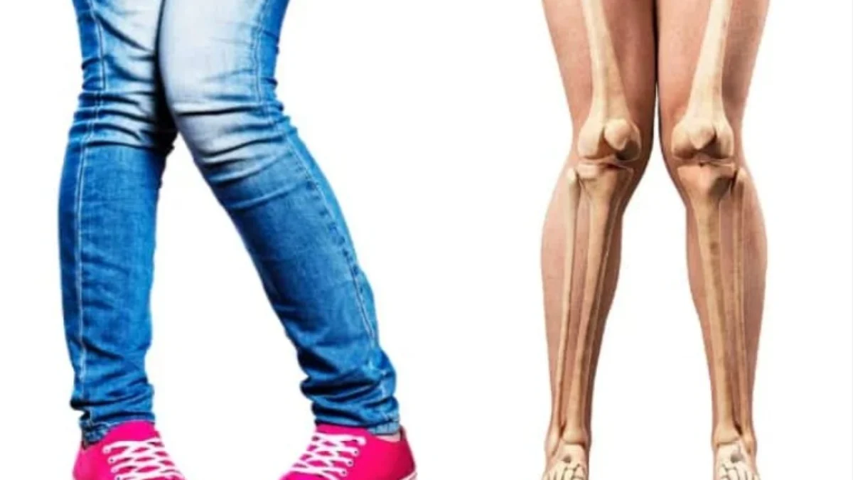 ILUSTRASI Kaki X yang bisa menjadi tanda-tanda Scoliosis
