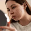 Ini 5 Serum Tranexamic Acid Ampuh Atasi Jerawat dan Hiperpigmentasi