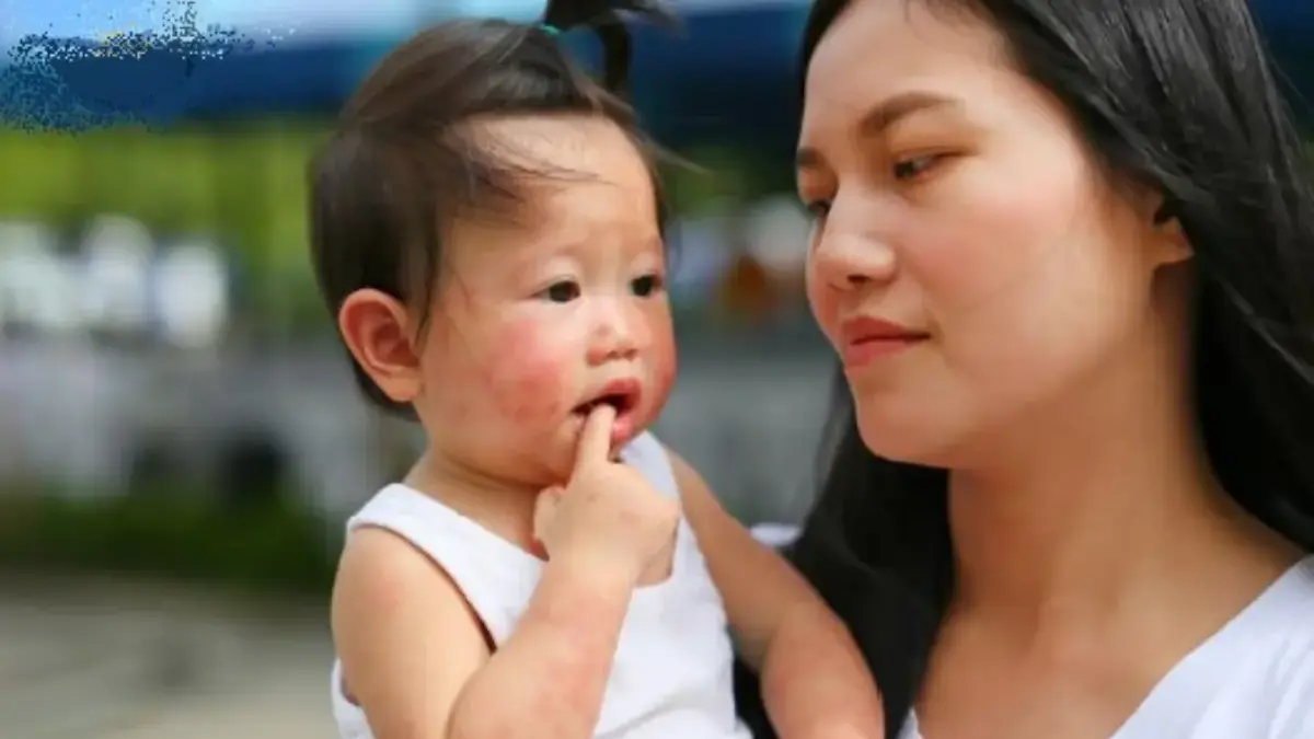 ILUSTRASI Anak yang terkena alergi. (freepik)