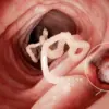 ILUSTRASI infeksi cacing gelang dalam tubuh manusia. (alodokter)