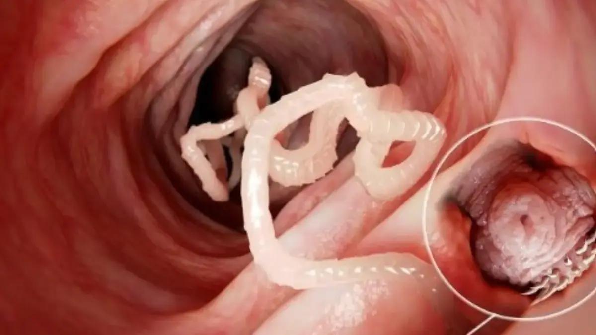 Cara Masuk Cacing Gelang ke Tubuh Manusia Hingga Terinfeksi ILUSTRASI infeksi cacing gelang dalam tubuh manusia. (alodokter)