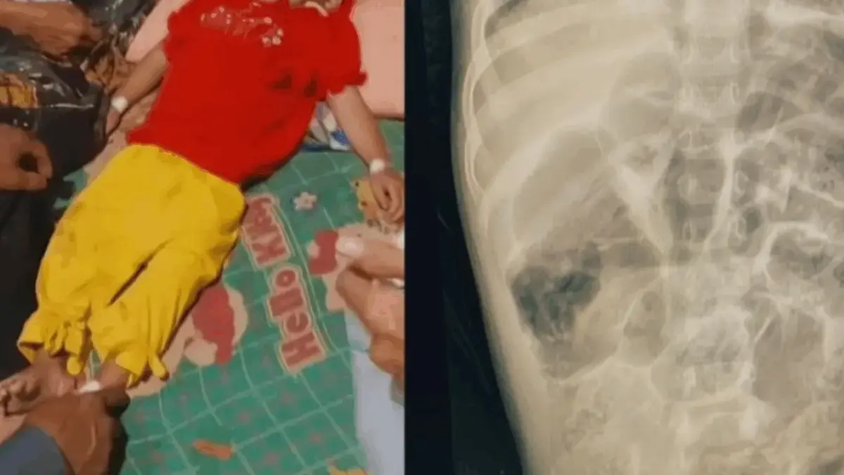 RS Beri Penjelasan Soal Balita di Sukabumi Meninggal Akibat Tubuh Dipenuhi Cacing