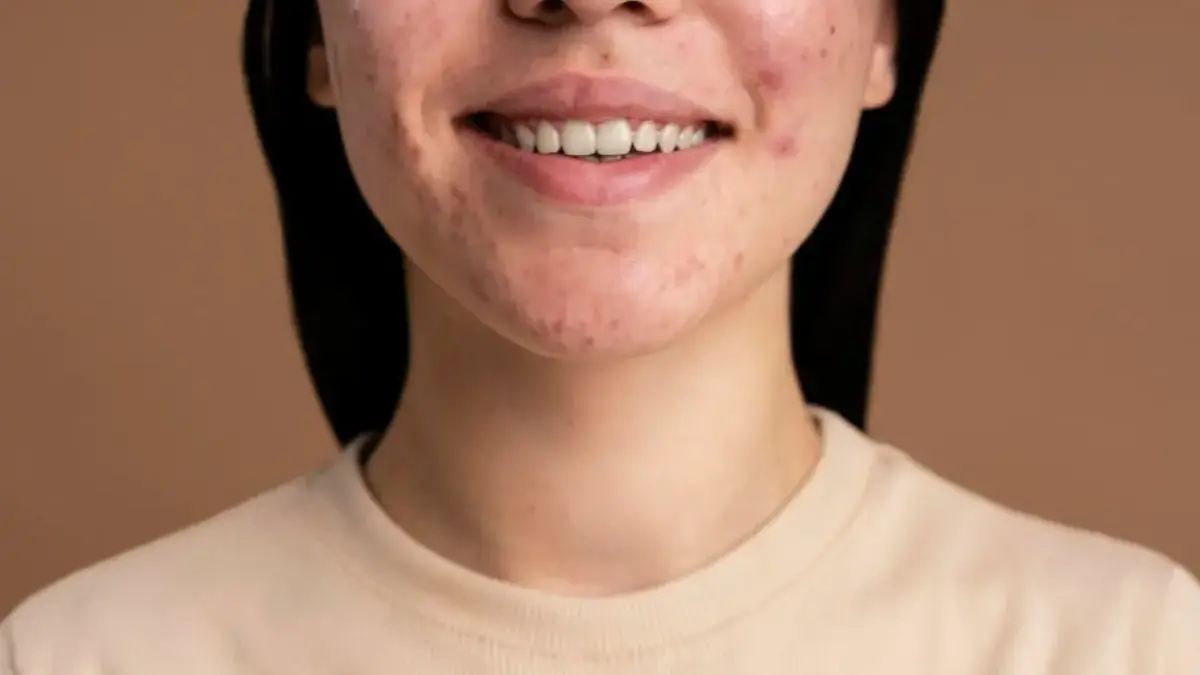 Skincare untuk Jerawat Batu