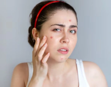 Stop! 5 Kesalahan Fatal yang Bikin Jerawat Makin Banyak Stop! 5 Kesalahan Fatal yang Bikin Jerawat Makin Banyak