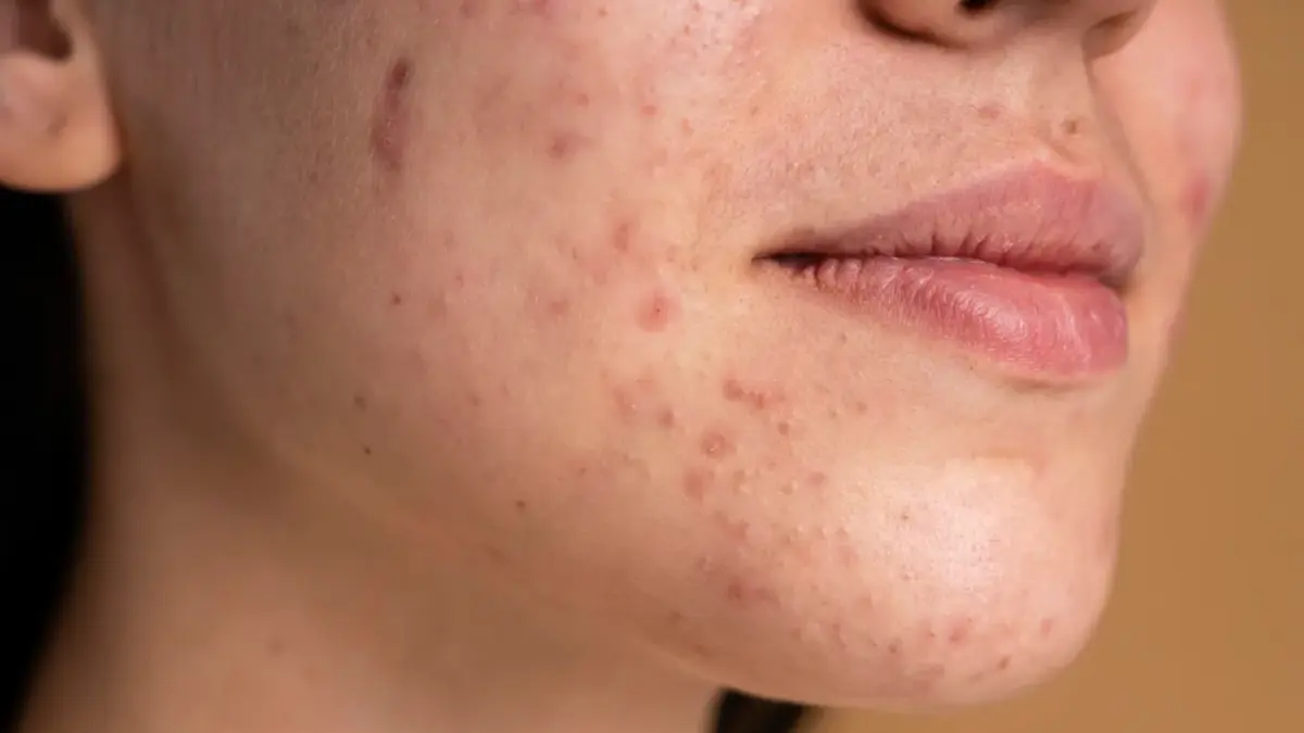 Cara Atasi Jerawat Hormonal: Ini Perawatan dan Pencegahan Menurut Para Ahli