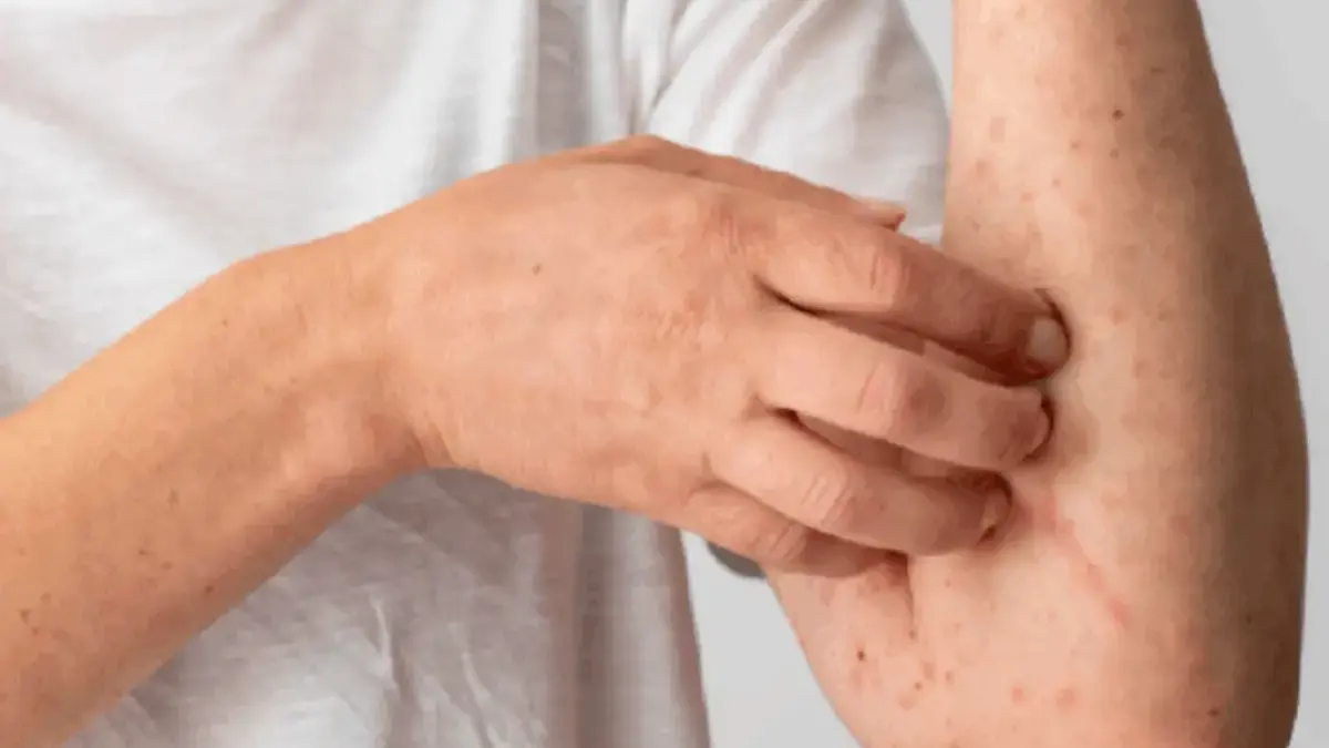 Apakah Campak Menular pada Orang Dewasa? Ini Fakta Penting yang Harus Kamu Pahami Apakah Campak Menular pada Orang Dewasa? Ini Fakta Penting yang Harus Kamu Pahami