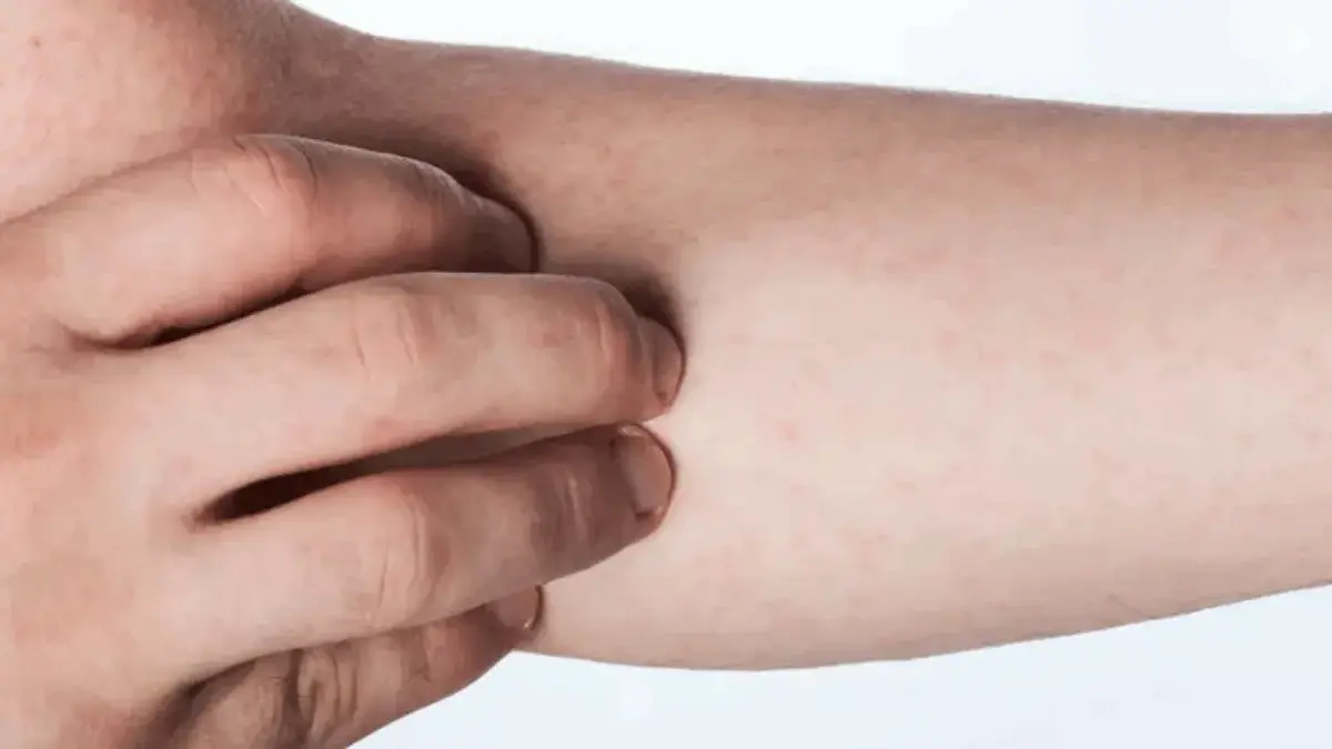 Dokter Internship Meninggal karena Campak, Kemenkes Angkat Bicara