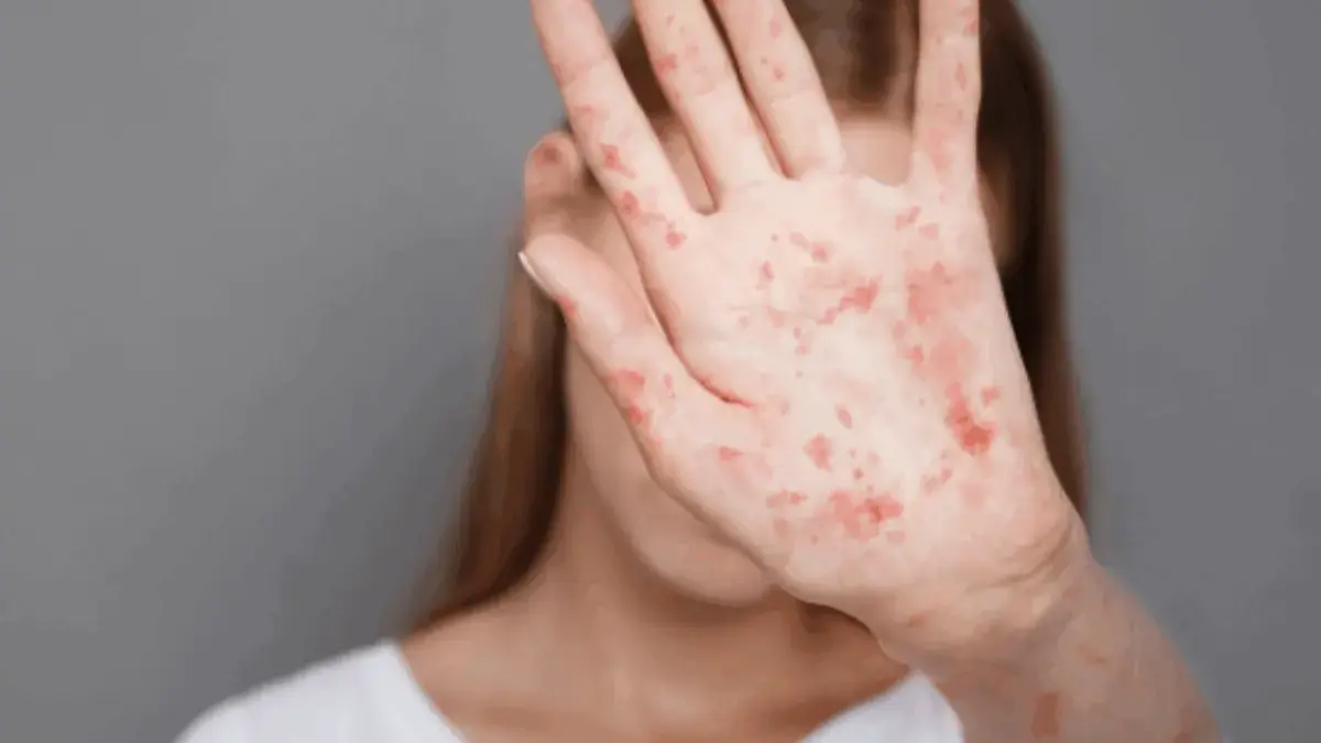 Campak Makin Menggila, Ini Ciri-Ciri yang Sering Tak Disadari Mirip Flu Namun Berujung Fatal Campak Makin Menggila, Ini Ciri-Ciri yang Sering Tak Disadari Mirip Flu Namun Berujung Fatal