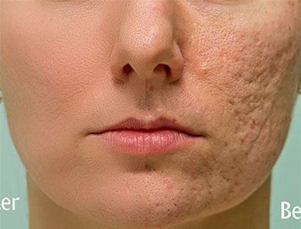 Atasi Bopeng di Wajah Dengan Laser Resurfacing / Laser Bopeng Apakah Ampuh?