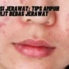 Mengatasi Jerawat: Tips Ampuh untuk Kulit Bebas Jerawat, Penasaran? Yuk Kepoin