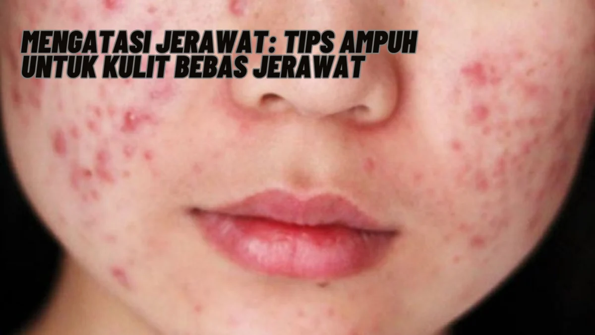 Mengatasi Jerawat: Tips Ampuh untuk Kulit Bebas Jerawat, Penasaran? Yuk Kepoin