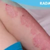 Psoriasis: Permasalahan Kulit yang Harus Diketahui