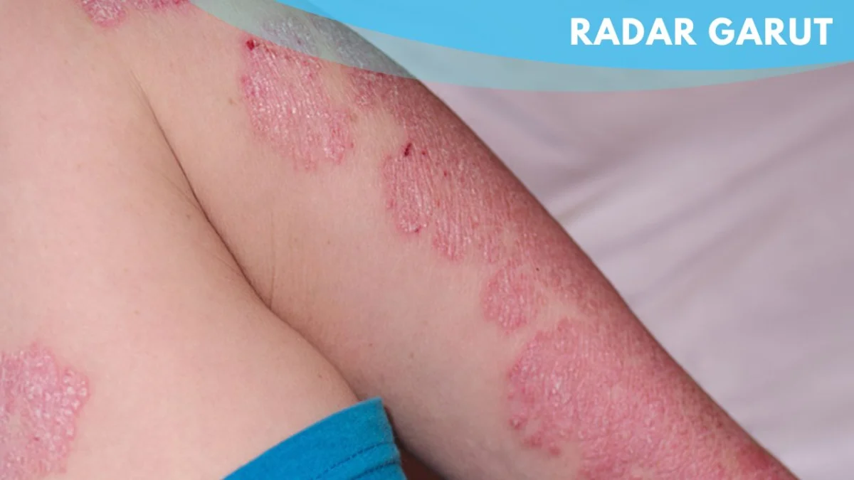 Psoriasis: Permasalahan Kulit yang Harus Diketahui