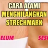 Ini 7 Tips Mengatasi Stretch Mark Setelah Melahirkan, Pake Metode Ini Bisa Menghilangkan Stretch Mark Dan Ketiak Hitam