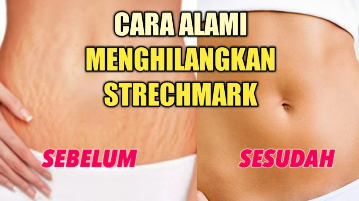 Ini 7 Tips Mengatasi Stretch Mark Setelah Melahirkan, Pake Metode Ini Bisa Menghilangkan Stretch Mark Dan Ketiak Hitam