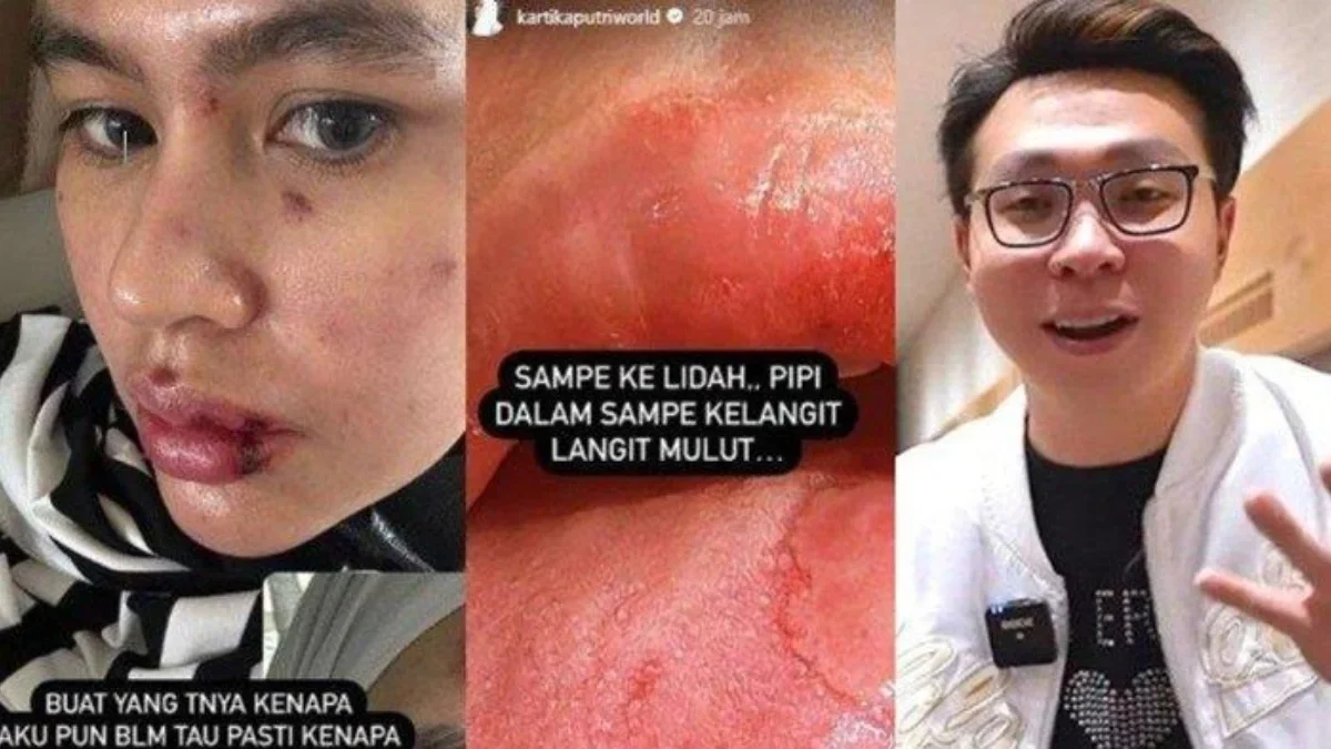 Tanggapan dr. Richard Lee Terkait Penyakit Autoimun Yang Dialami Kartika Putri