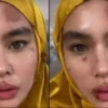 Kartika Putri Alami Autoimun