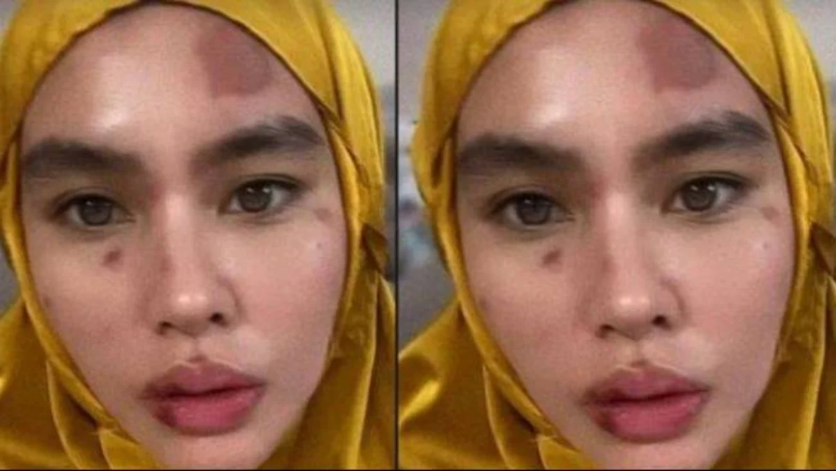 Kartika Putri Alami Autoimun