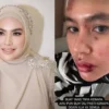 Kartika Putri Alami Autoimun