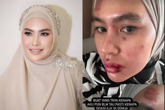 Kartika Putri Alami Autoimun