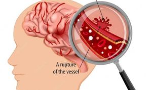 Gejala Stroke yang Patut diwaspadai Sejak Dini