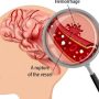 Gejala Stroke yang Patut diwaspadai Sejak Dini